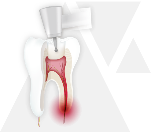 endodontie step 2