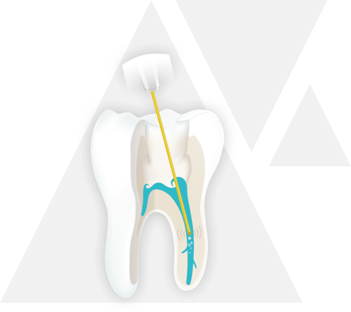 endodontie step 4